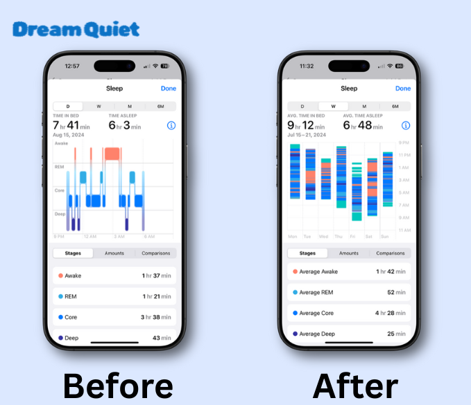DreamQuiet™ Anti-Snoring Mouthpiece